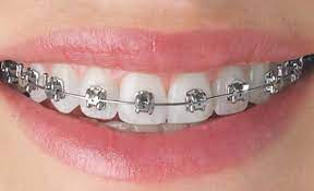 Best Orthodontic Treatment